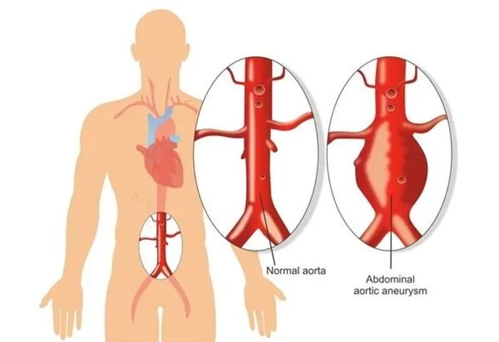 Waspada Aneurisma Aorta, “Pembunuh Diam-Diam” yang Bisa Mengancam Nyawa
